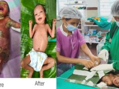 अत्यंत दुर्लभ बीमारी से जूझ रहे नवजात को बीजापुर जिला अस्पताल की SNCU में मिला नया जीवन